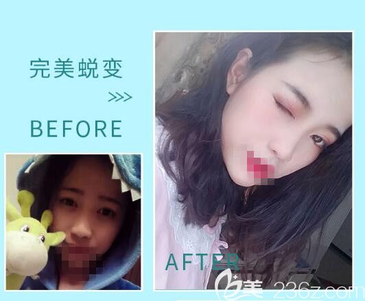 駱豫醫(yī)生顧客 鼻綜合手術前后對比照片