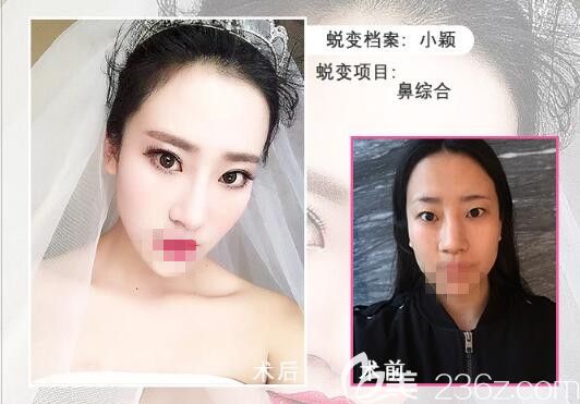 駱豫醫(yī)生顧客 鼻綜合手術前后對比照片