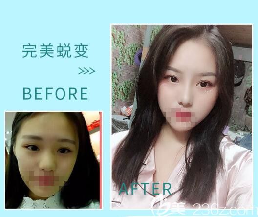 駱豫醫(yī)生顧客 自體脂肪填充前后對比照片