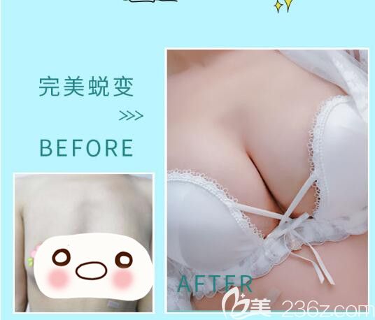 駱豫醫(yī)生顧客 假體隆胸填充前后對比照片
