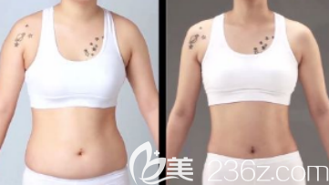 這是我吸脂前后的對比照片