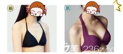 徐國建醫(yī)生做假體豐胸術(shù)后效果
