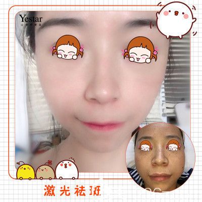 武漢藝星激光祛斑術(shù)后43天恢復(fù)效果