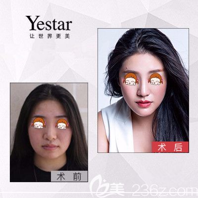 洪霞院長做BTL緊膚除皺真人案例