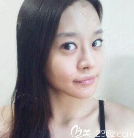 韓國綺林整形外科 輪廓做的好嗎