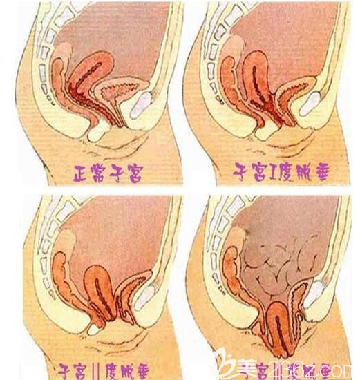 正常子宮與子宮下垂級(jí)別化分示意圖 正常子宮與子宮下垂級(jí)別化分示意圖