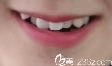 沈陽(yáng)百嘉麗口腔牙齒矯正術(shù)前照 沈陽(yáng)百嘉麗口腔牙齒矯正術(shù)前照