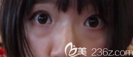 術前我的眼袋和淚溝的樣子 術前我的眼袋和淚溝的樣子