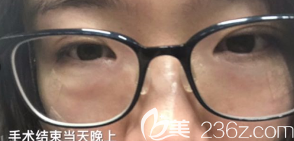 做淚溝和激光去眼袋手術結束的當天晚上 做淚溝和激光去眼袋手術結束的當天晚上