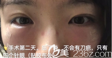 濟南激光去眼袋+自體脂肪填充淚溝第二天的<span style= 濟南激光去眼袋+自體脂肪填充淚溝第二天的<span style=