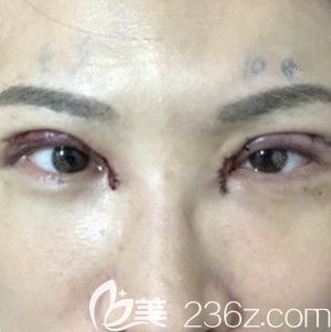 在韓國芭堂做雙眼皮修復手術當天 在韓國芭堂做雙眼皮修復手術當天