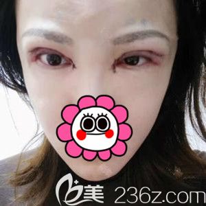 在韓國芭堂做雙眼皮修復手術后2天 在韓國芭堂做雙眼皮修復手術后2天