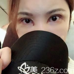 在韓國芭堂做雙眼皮修復手術后1周 在韓國芭堂做雙眼皮修復手術后1周