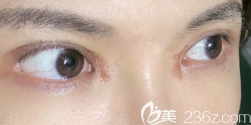 在韓國芭堂做雙眼皮修復手術后10天 在韓國芭堂做雙眼皮修復手術后10天