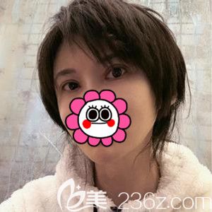 在韓國芭堂做雙眼皮修復手術后1個月 在韓國芭堂做雙眼皮修復手術后1個月