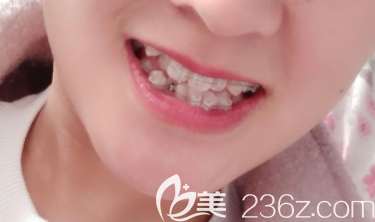 沈陽(yáng)百嘉麗口腔陶瓷托槽正畸術(shù)中照 沈陽(yáng)百嘉麗口腔陶瓷托槽正畸術(shù)中照