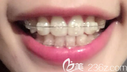 在沈陽百嘉麗口腔做陶瓷托槽矯正才1年，我這么凌亂的牙齒居然就排齊了！