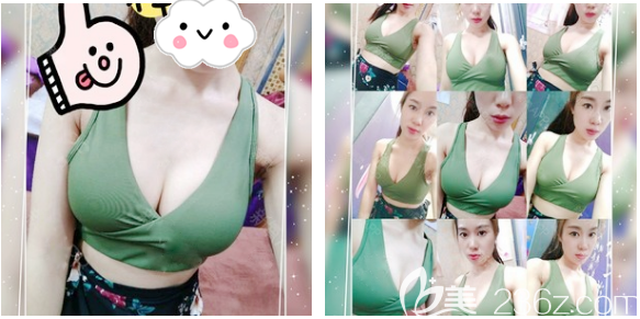 假體隆胸術(shù)后22天恢復(fù)效果圖