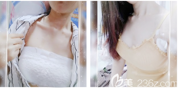 東莞壹加壹假體隆胸7天拆線