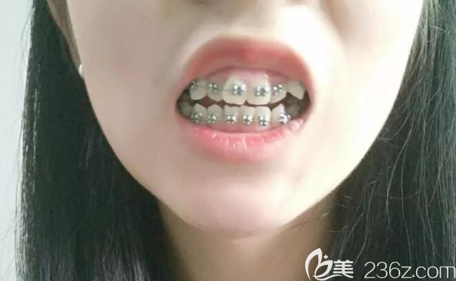 高景梅矯正深覆合<span style= 高景梅矯正深覆合<span style=