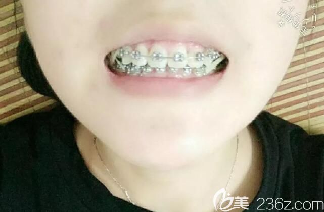 聊城口腔醫(yī)院帶牙套328天 聊城口腔醫(yī)院帶牙套328天