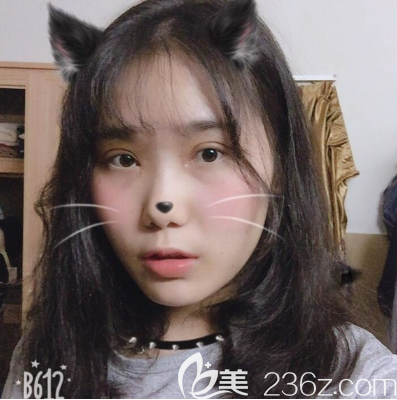 東莞壹加壹雙眼皮7天拆線 東莞壹加壹雙眼皮7天拆線