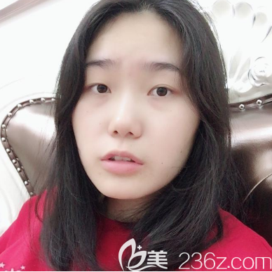 在東莞壹加壹做雙眼皮術(shù)前照片 在東莞壹加壹做雙眼皮術(shù)前照片