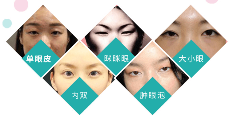 大小眼等眼部問題示意圖