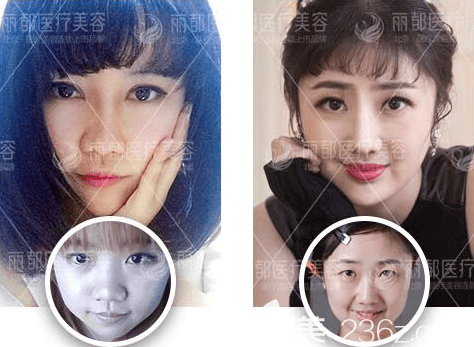 北京米蘭柏羽麗都雙眼皮案例