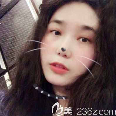 東莞壹加壹梅小霞割雙眼皮案例 東莞壹加壹梅小霞割雙眼皮案例