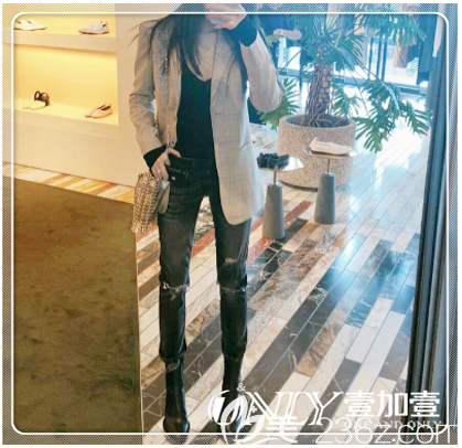 大腿環(huán)吸術(shù)后一個月效果圖