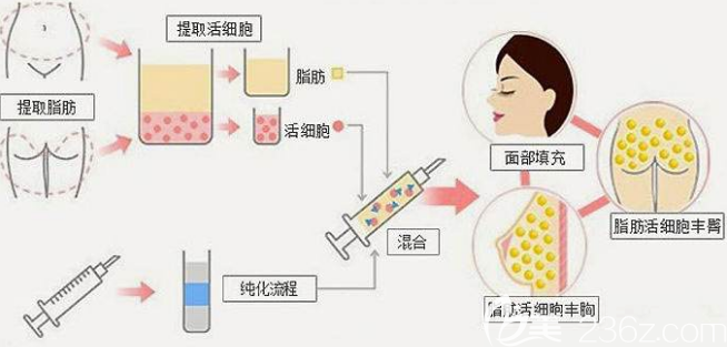 自體脂肪移植過程 自體脂肪移植過程
