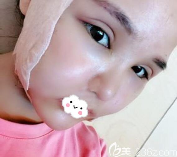 韓國UcanB整形醫(yī)院假體隆胸1年后做面部輪廓整形真人案例