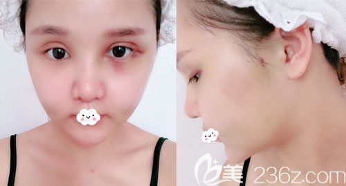 韓國UcanB整形醫(yī)院面部輪廓術(shù)后7天恢復(fù)效果