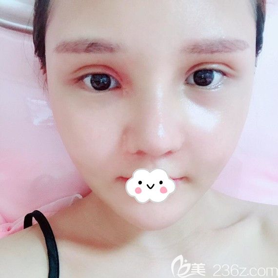 韓國UcanB顴骨顴弓整形術(shù)后1個(gè)月案例恢復(fù)效果圖