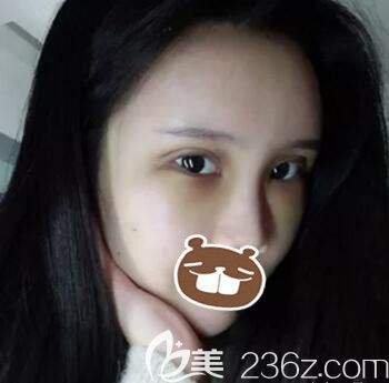 全臉脂肪填充+全切雙眼皮術(shù)后3天效果