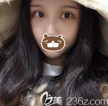 在亞韓做切開雙眼皮+脂肪填充面部一周拆線