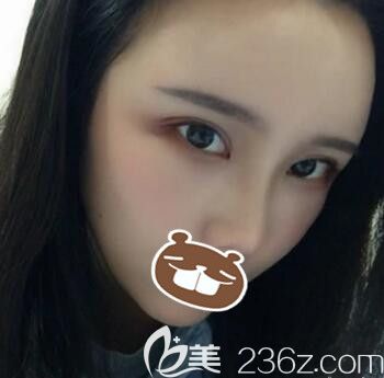 做面部脂肪填充+切開雙眼皮術(shù)后半個月恢復(fù)效果照