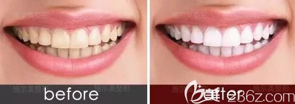 江蘇施爾美冷光美白牙齒案例對比
