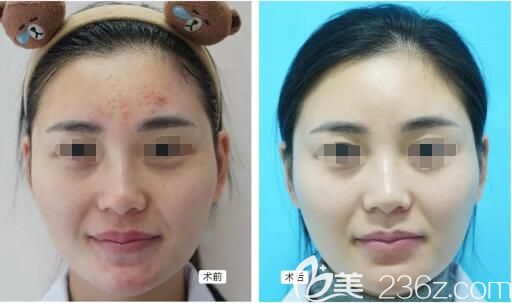 到江蘇施爾美做美白祛痘案例