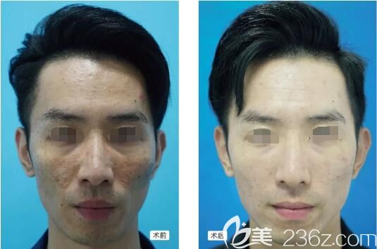 江蘇南京施爾美分享果酸換膚案例