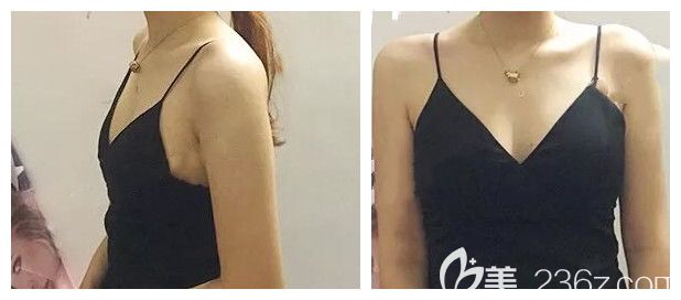 我在南寧美麗星整形做隆胸手術(shù)前的照片 我在南寧美麗星整形做隆胸手術(shù)前的照片