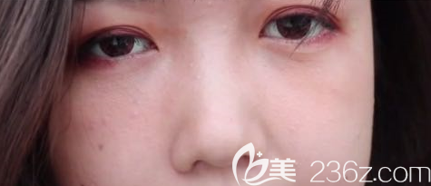 總結我在威海做了內切去眼袋+自體脂肪填充淚溝后的一些心得and照片和注意事項