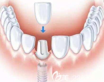 洛陽九龍口腔鄭淑敏介紹單顆牙缺失需要及時修復 洛陽九龍口腔鄭淑敏介紹單顆牙缺失需要及時修復