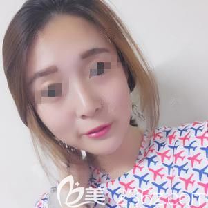 在張家口維多利亞做激光祛斑術(shù)后一周雀斑消失