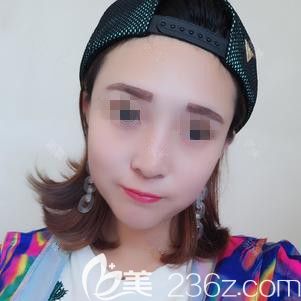 邱榮強(qiáng)醫(yī)生為我做激光去斑術(shù)后12天皮膚潔白無(wú)瑕