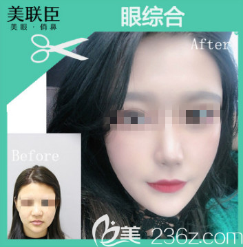 大概2月底去淄博做了去眼袋手術恢復了4個月了，我今天分享我的照片+心得