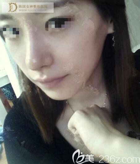 不忍直視鷹鉤鼻在韓國女神整形做了矯正變成了溫柔的小姐姐