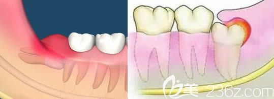 王冠一醫(yī)生講解什么樣的智齒需要拔除 王冠一醫(yī)生講解什么樣的智齒需要拔除