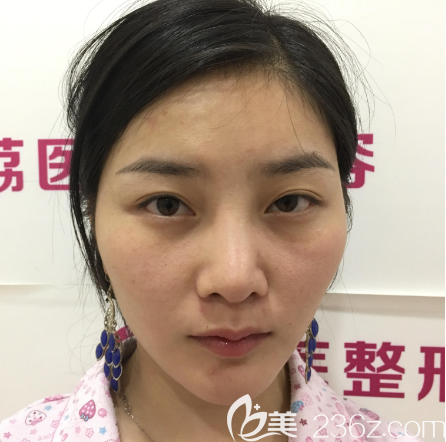 在廣州荔醫(yī)做雙眼皮的術(shù)前照片 在廣州荔醫(yī)做雙眼皮的術(shù)前照片